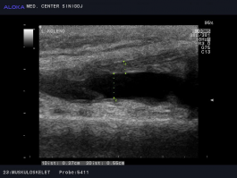 Ultrazvok kolena - sinovitis v levem kolenu